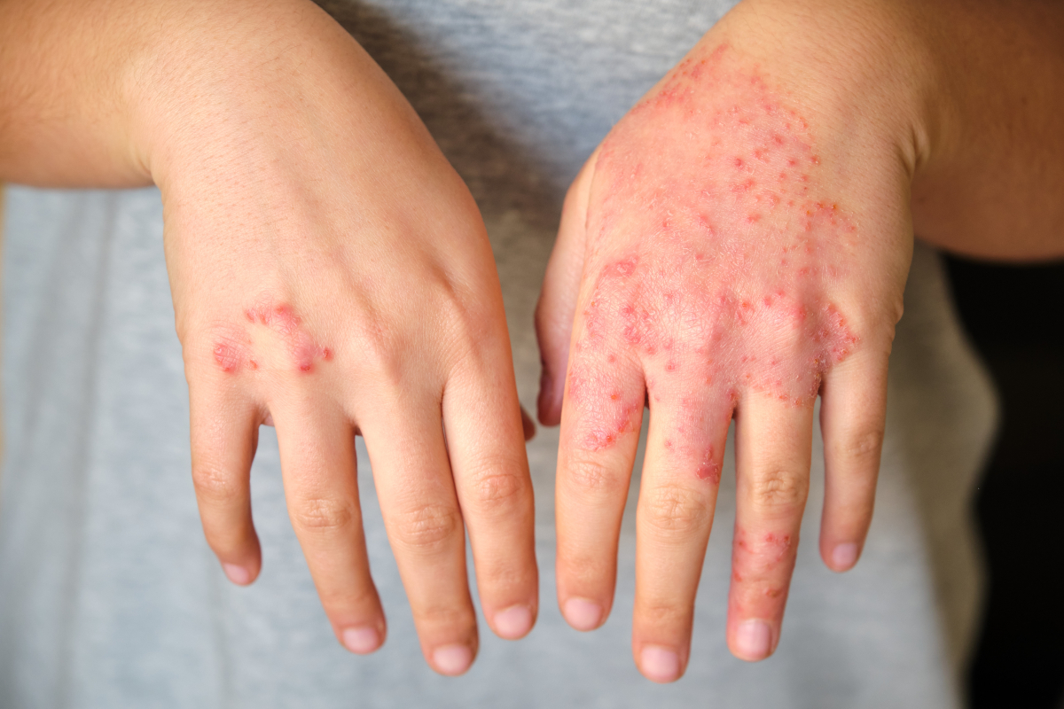 maladie Dermatite herpétiforme